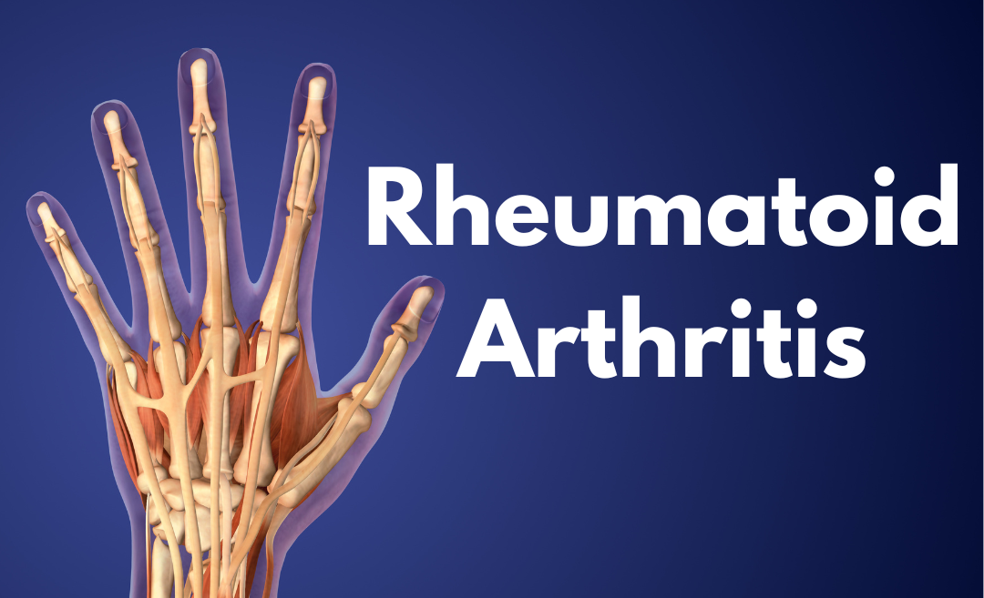 rheumatoid image